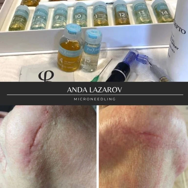 Anda Lazarov: Locul I la Microneedling la Geneva 2020